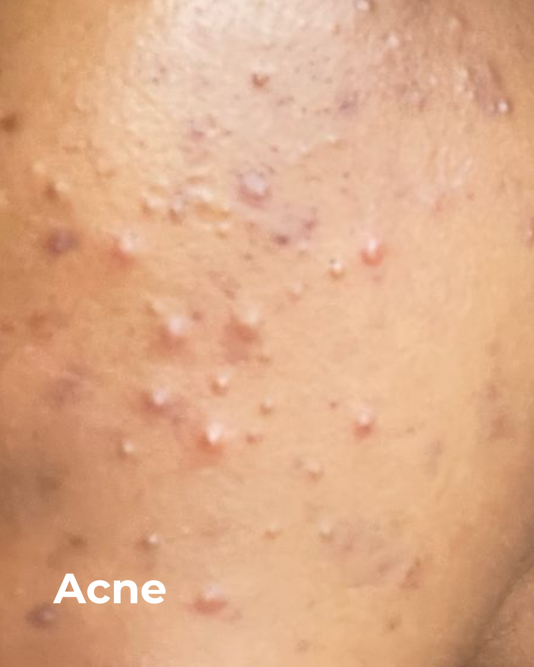 Acne