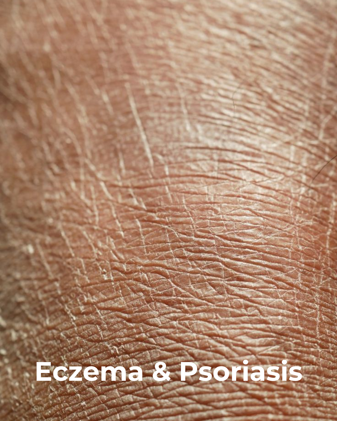 Inflammation & Eczema