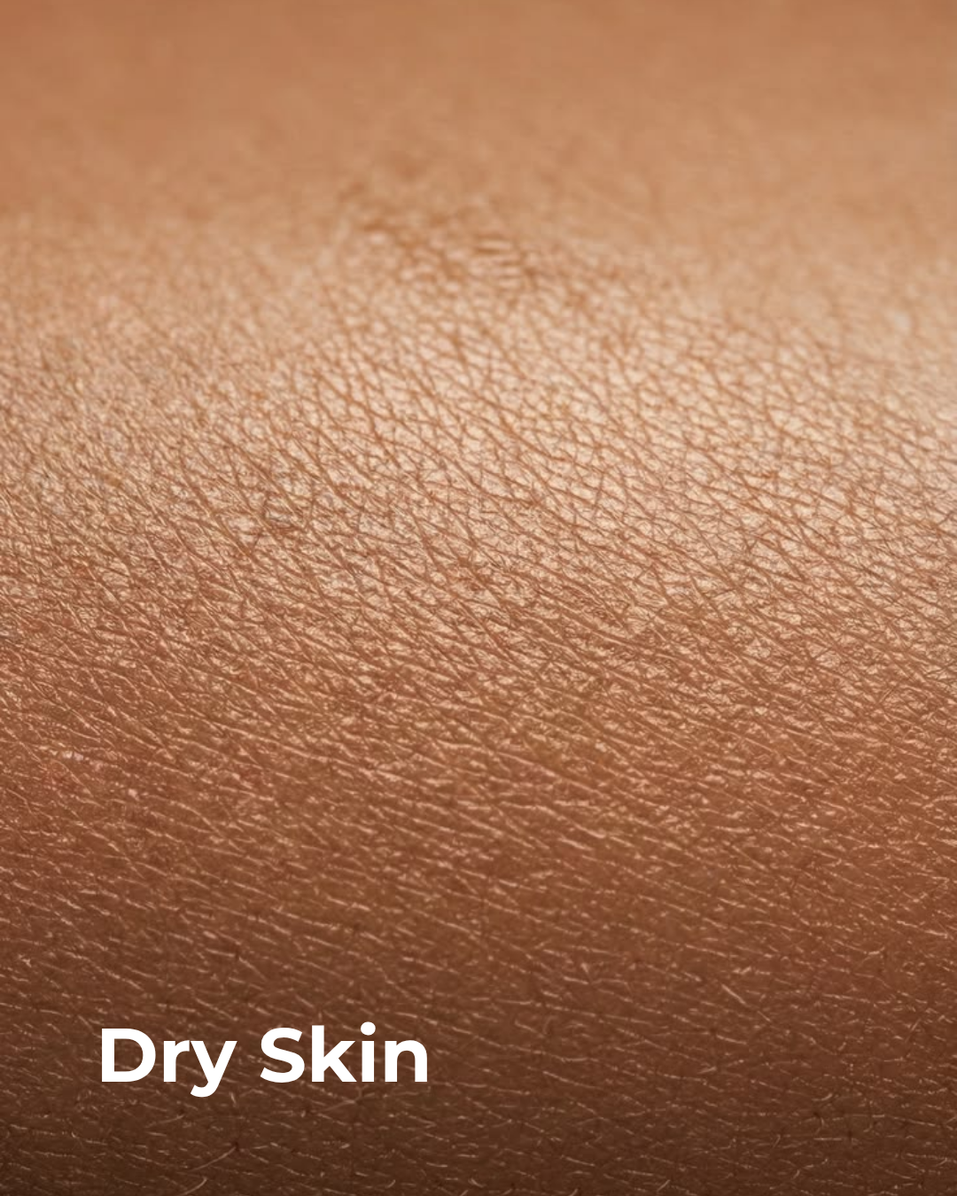 Dry Skin