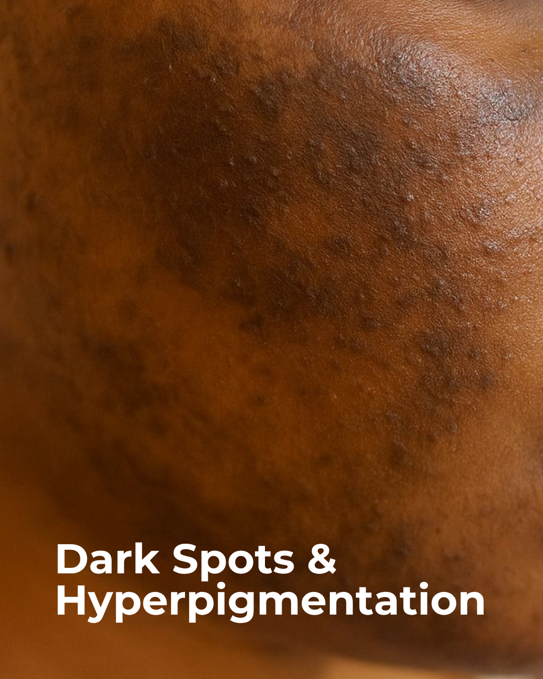 Hyperpigmentation